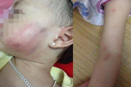 Xác minh vụ bé gái 16 tháng tuổi bị thâm tím mặt tại trường mầm non