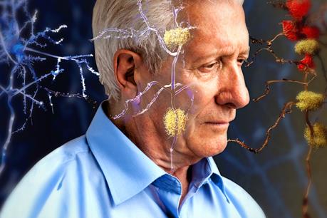 Mất nhiễm sắc thể Y có thể làm tăng nguy cơ mắc bệnh Alzheimer