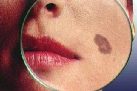 Phát hiện sớm ung thư da thông qua các đốm đỏ trên cơ thể