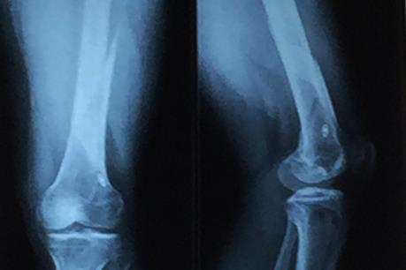 Phát minh vật liệu sinh học mới kích thích tái tạo xương