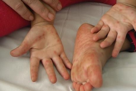 Cảnh báo: Tiềm ẩn lây lan bệnh tay chân miệng trên diện rộng tại TP Hồ Chí Minh