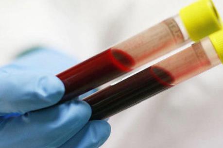 Phương pháp mới trong việc điều trị bệnh thiếu máu hồng cầu lưỡi liềm