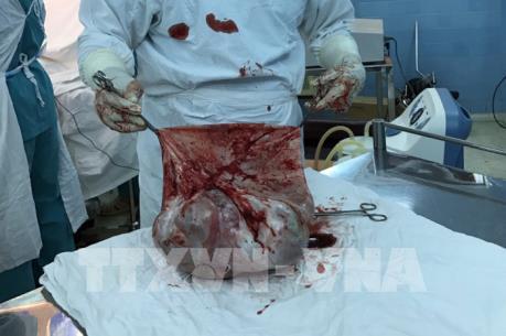 TP Hồ Chí Minh: Phẫu thuật khối u buồng trứng nặng 35 kg