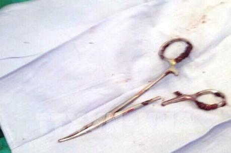 Chiếc panh để quên trong bụng bệnh nhân 18 năm đã han gỉ và đâm thủng đại tràng