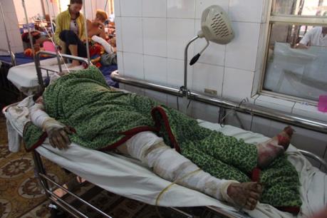 Sự phục hồi kỳ diệu của một bệnh nhân bỏng xăng 75% cơ thể