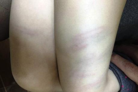 Cô giáo mầm non dùng đũa đánh thâm tím đùi trẻ bị chấm dứt hợp đồng lao động