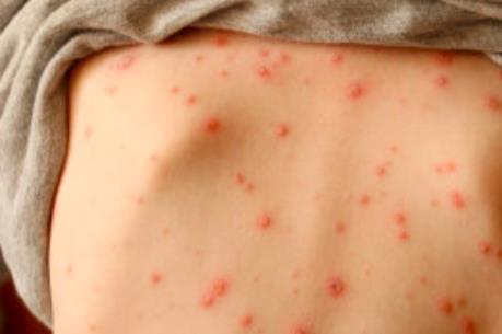 Bệnh thủy đậu và một số quan niệm sai lầm dẫn đến biến chứng nguy hiểm