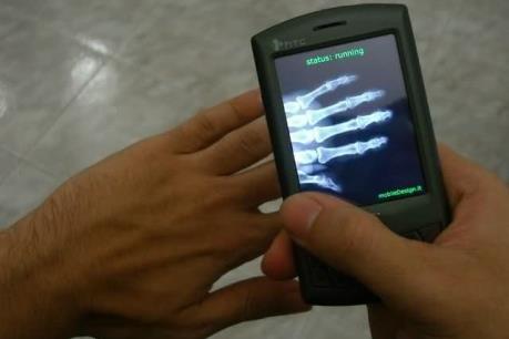 Ảnh chụp X-quang bằng smartphone giúp chẩn đoán bệnh về phổi