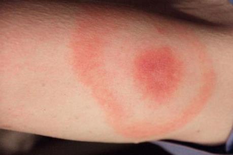 Canada cảnh báo dịch bệnh do bọ ve lây truyền trong mùa du lịch