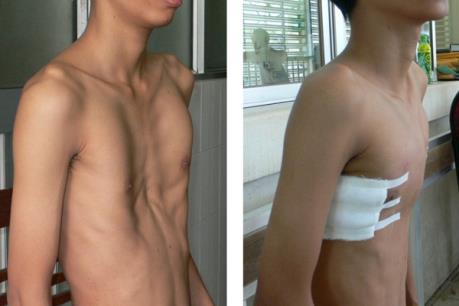 Cảnh báo gia tăng bệnh lõm ngực ở trẻ em