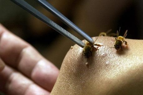 Diễn biến sức khỏe của 14 nạn nhân bị đàn ong tấn công tại Nghệ An