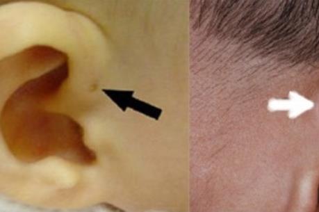Phẫu thuật thành công trường hợp bị nhiễm trùng lỗ rò luân nhĩ hiếm gặp