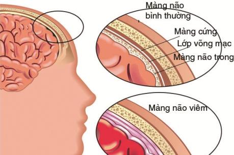 Cảnh báo những nguy hiểm của bệnh viêm não