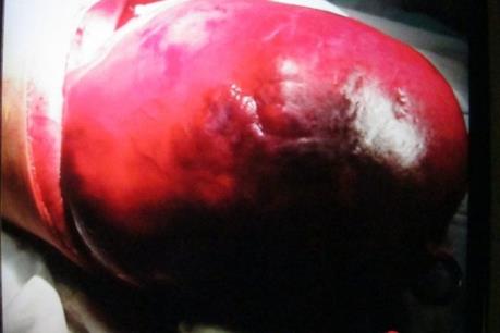 Phẫu thuật một phần bướu máu khổng lồ ở mặt cho cô gái trẻ