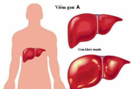 Bộ Y tế khuyến cáo phòng chống dịch bệnh do vi rút viêm gan A