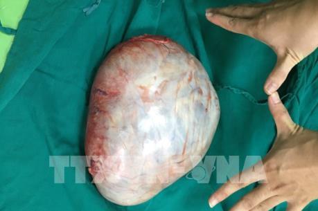 Phẫu thuật thành công lấy u quái buồng trứng nặng gần 4 kg
