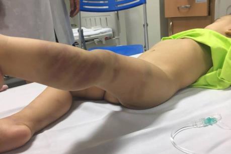 Vụ bé trai 1 tuổi nghi bị bạo hành: Quyết định khởi tố vụ án