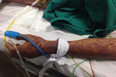 Bệnh liên cầu lợn ở người và cách phòng chống