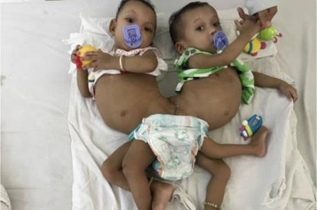 Tách thành công hai bé gái song sinh dính nhau hậu môn và tủy sống