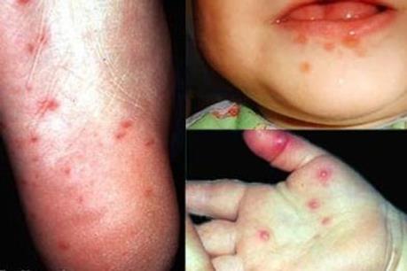 Bộ Y tế: Thời tiết giao mùa khiến bệnh tay chân miệng ở trẻ em gia tăng