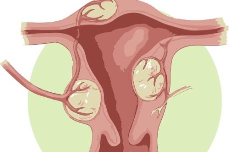 Bệnh viện Cần Thơ bóc tách thành công u xơ 4 kg cho nữ bệnh nhân