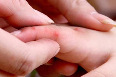 Bệnh tay chân miệng gia tăng mạnh