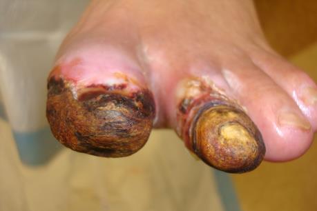 Anh: Số ca cắt cụt chi vì biến chứng bệnh tiểu đường tăng cao kỷ lục