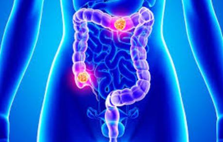 Trung Quốc: Gia tăng tỷ lệ nhân viên văn phòng bị ung thư ruột kết