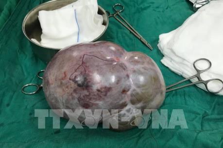 Kon Tum: Bóc tách khối u buồng trứng nặng gần 4 kg