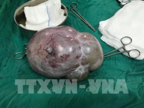 Cắt u buồng trứng nặng 6 kg cho một bệnh nhân nhiễm HIV  