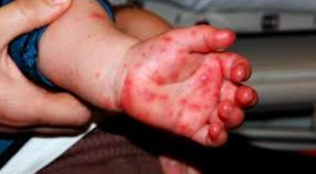 Bệnh tay chân miệng bùng phát tại Malaysia