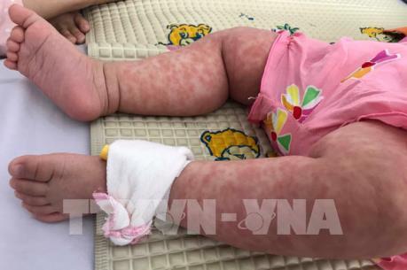 Nhiều trẻ nhập viện vì bệnh sởi, đa số chưa được tiêm phòng