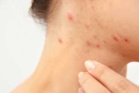 Đình chỉ lưu hành serum trị mụn Acne control serum