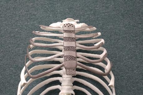 Cấy ghép thành công xương ngực và xương sườn chất liệu titan bằng công nghệ in 3D