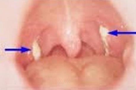 Bệnh bạch hầu xuất hiện trở lại, đã có 2 trường hợp tử vong