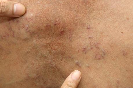 Bộ Y tế hướng dẫn người dân cách phòng bệnh sán dây lợn