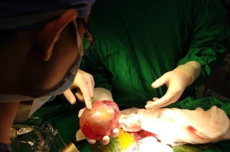 Tp. Hồ Chí Minh phẫu thuật lấy khối u thai cho bé trai 4 tháng tuổi