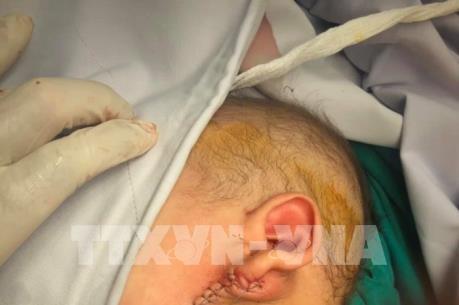 Phẫu thuật khối bướu khổng lồ cho bệnh nhi 12 tháng tuổi