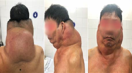 Phẫu thuật khối u cho “người gấu” ở Hải Phòng