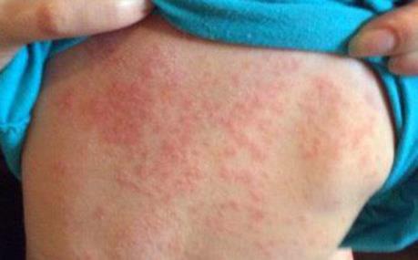 Số ca nhiễm sởi tại Mỹ tăng mạnh