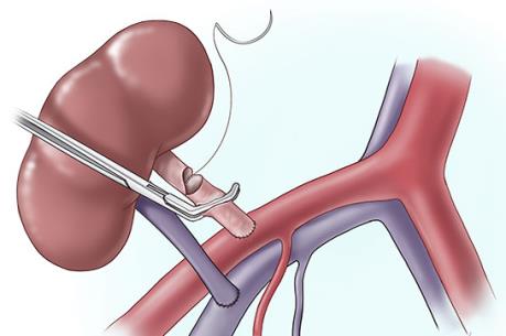 Tìm ra phương pháp phục hồi chức năng thận để cấy ghép