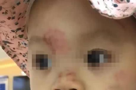 Hải Phòng: Bé 14 tháng tuổi bị bầm tím mặt sau ngày đầu đi học