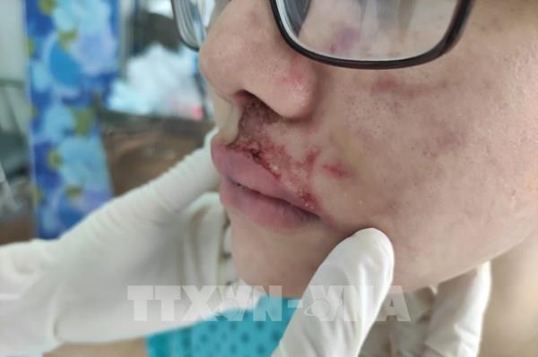 Cảnh báo hậu quả nặng nề do tai biến khi tiêm filler làm đẹp