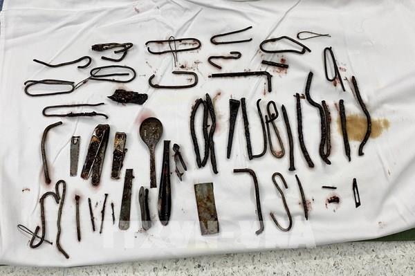 Phẫu thuật lấy ra khoảng 1 kg kim loại trong bụng một bệnh nhân