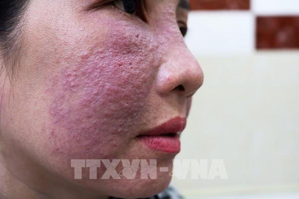 Cảnh báo tiền mất tật mang vì làm trắng da cấp tốc đón Tết