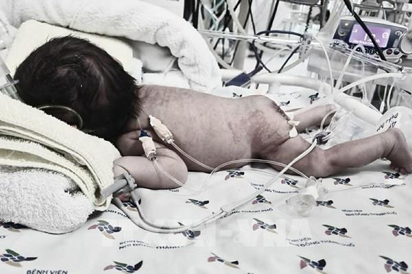 Phẫu thuật thành công bướu quái khổng lồ ở trẻ sơ sinh  ​