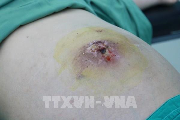 Điều trị u xơ tử cung phản khoa học, cô gái trẻ mất cơ hội làm mẹ