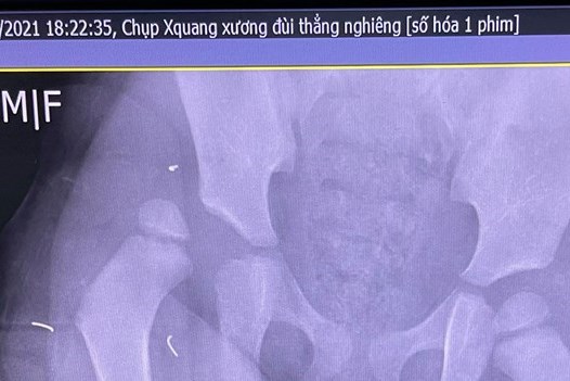 Tin mới nhất về sức khỏe bé gái rơi từ tầng 13 chung cư