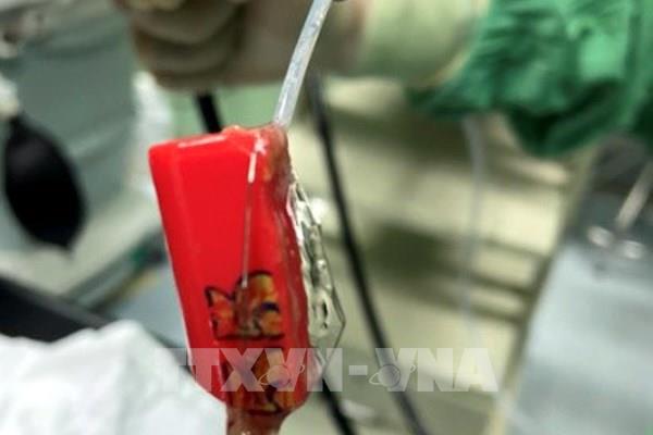 Ca cấp cứu hy hữu: Gắp bật lửa gas từ dạ dày bệnh nhân