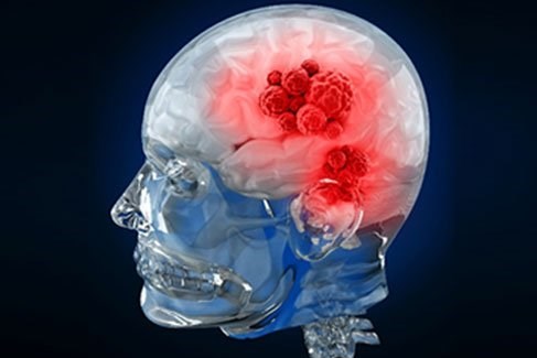 Caffeine có tác dụng chống lại khối u ác tính